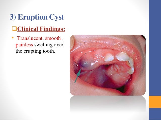 Cysts and tumors in pediatric dentistry