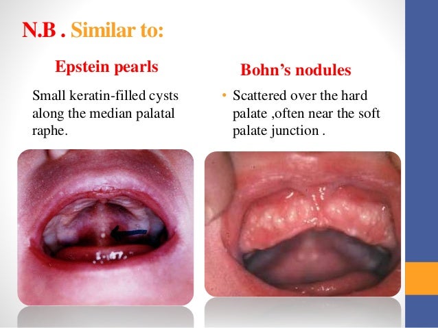 Dental cysts | Cambridge University Hospitals - CUH