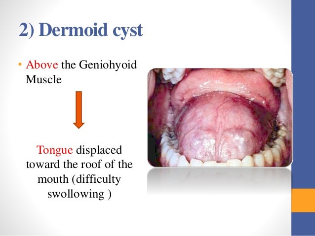 Oral Dermoid Cyst 30