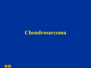 Chondrosarcoma