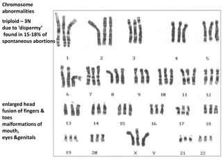 Chromosome
abnormalities

triploid – 3N
due to ‘dispermy’
found in 15-18% of
spontaneous abortions

enlarged head
fusion of fingers &
toes
malformations of
mouth,
eyes &genitals

 