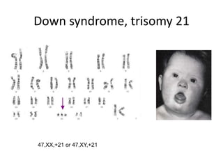 Down syndrome, trisomy 21

47,XX,+21 or 47,XY,+21

 