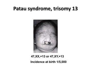 Patau syndrome, trisomy 13

47,XX,+13 or 47,XY,+13
Incidence at birth 1/5,000

 
