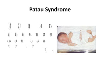 Patau Syndrome

 