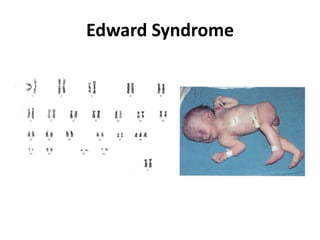 Edward Syndrome

 
