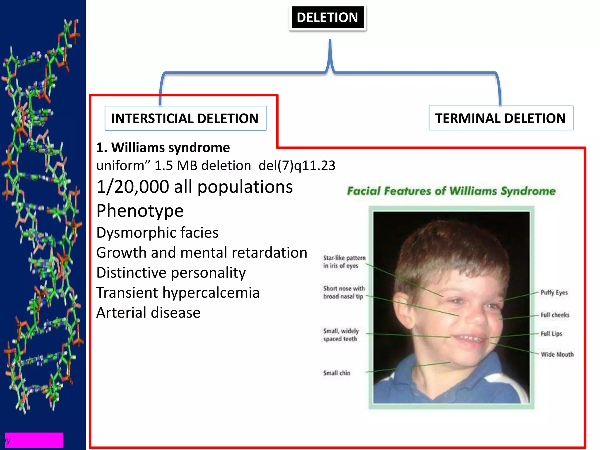 DELETION
INTERSTICIAL DELETION TERMINAL DELETION
1. Williams syndrome
uniform” 1.5 MB deletion del(7)q11.23
1/20,000 all populations
Phenotype
Dysmorphic facies
Growth and mental retardation
Distinctive personality
Transient hypercalcemia
Arterial disease
 