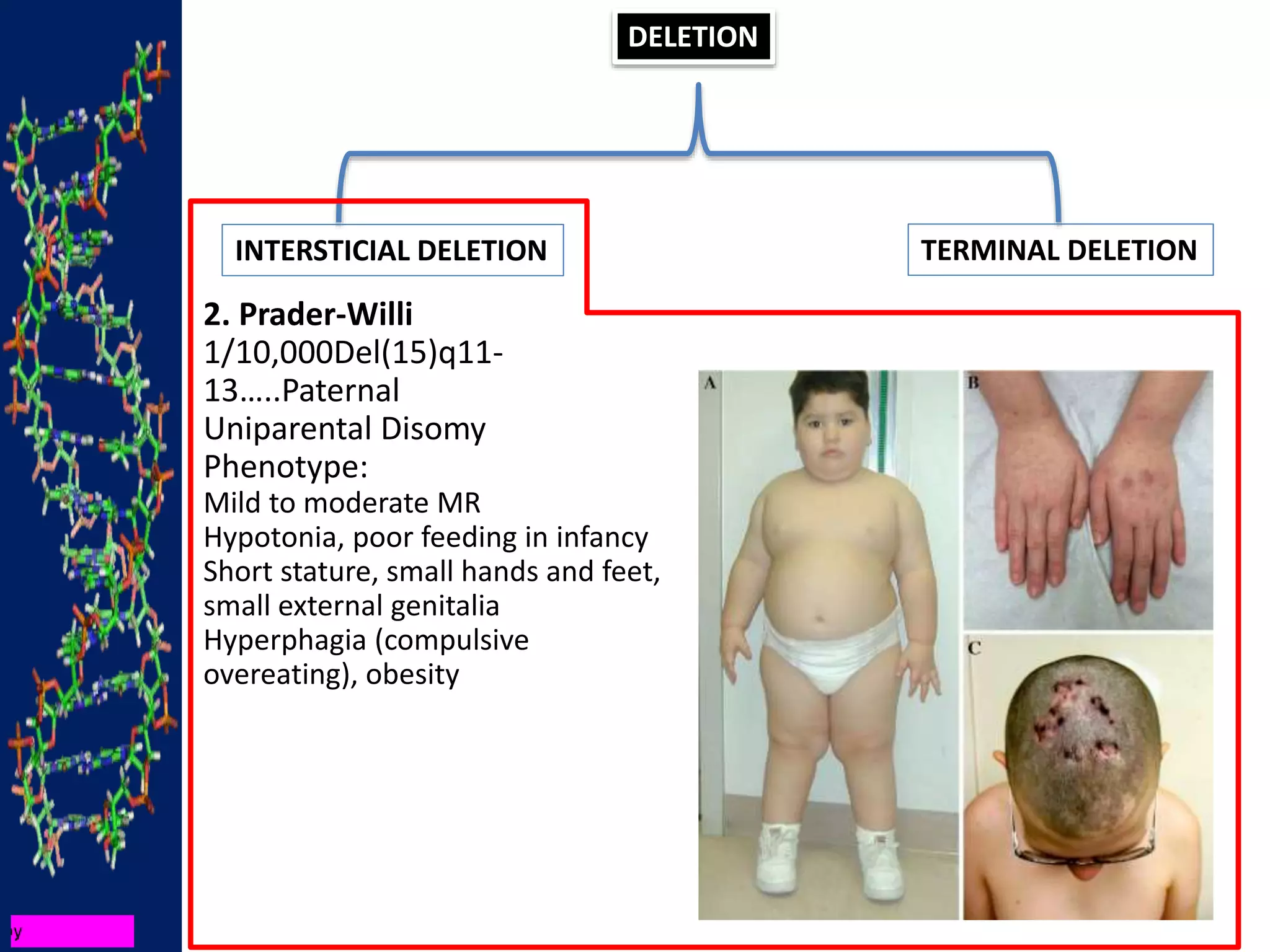 DELETION
INTERSTICIAL DELETION TERMINAL DELETION
2. Prader-Willi
1/10,000Del(15)q11-
13…..Paternal
Uniparental Disomy
Phenotype:
Mild to moderate MR
Hypotonia, poor feeding in infancy
Short stature, small hands and feet,
small external genitalia
Hyperphagia (compulsive
overeating), obesity
 