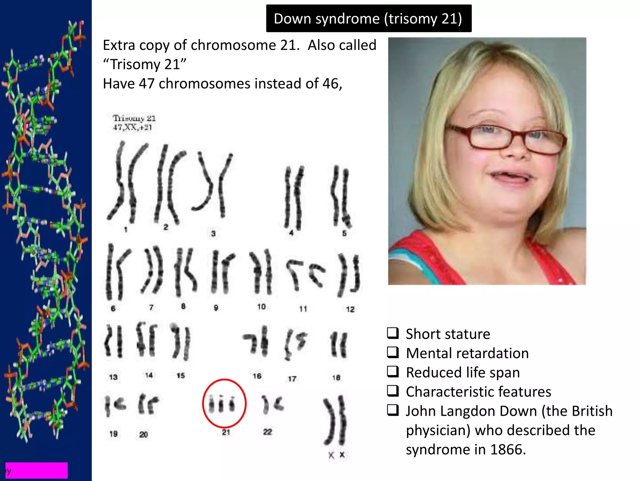 Extra copy of chromosome 21. Also called
“Trisomy 21”
Have 47 chromosomes instead of 46,
Down syndrome (trisomy 21)
 Short stature
 Mental retardation
 Reduced life span
 Characteristic features
 John Langdon Down (the British
physician) who described the
syndrome in 1866.
 