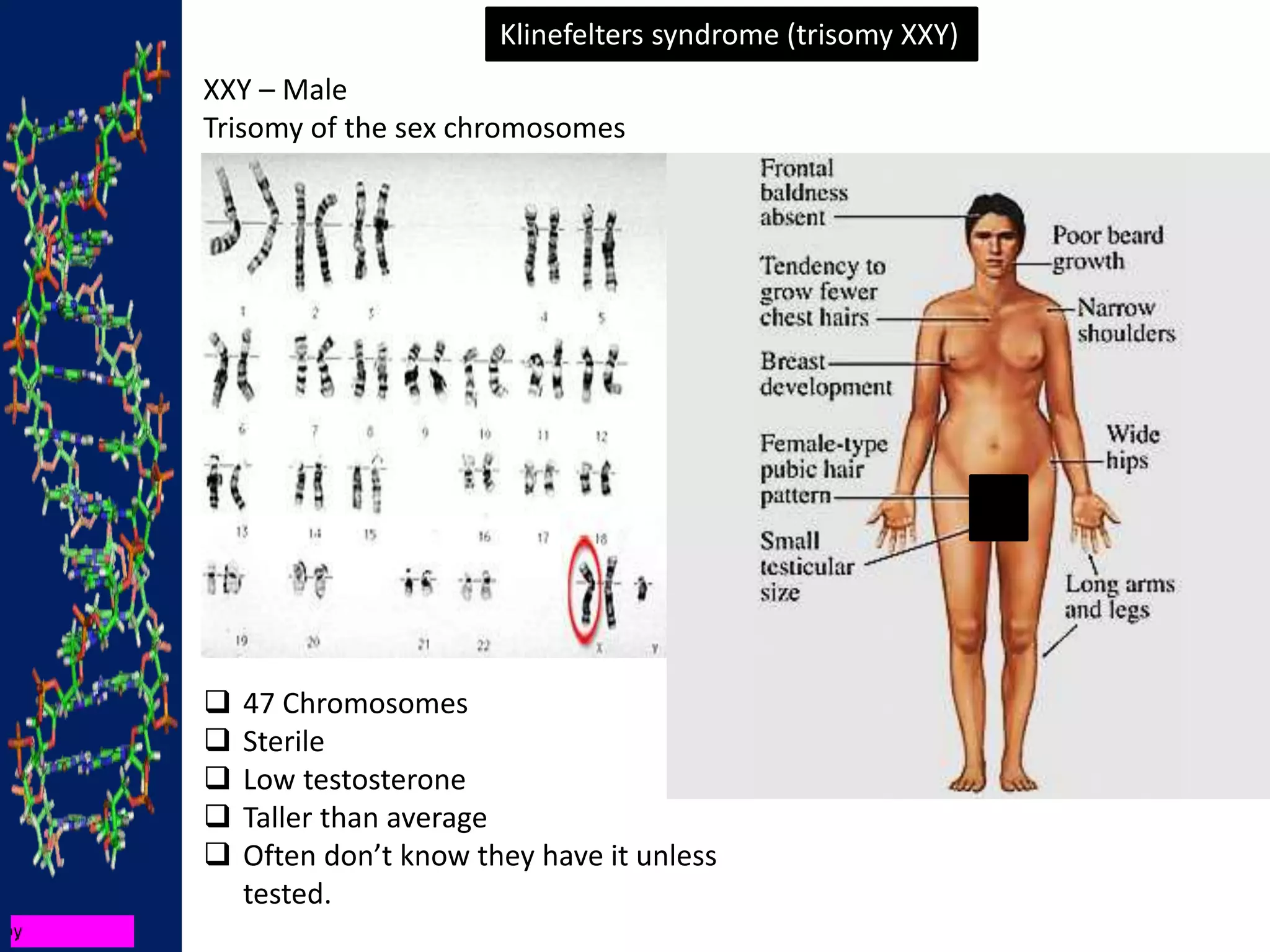 Klinefelters syndrome (trisomy XXY)
XXY – Male
Trisomy of the sex chromosomes
 47 Chromosomes
 Sterile
 Low testosterone
 Taller than average
 Often don’t know they have it unless
tested.
 