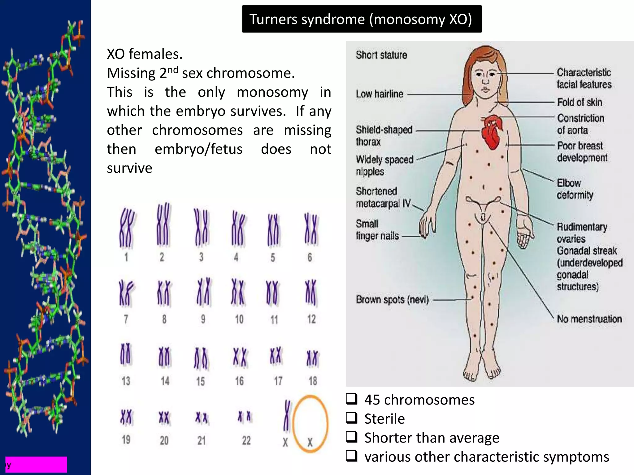 Turners syndrome (monosomy XO)
 45 chromosomes
 Sterile
 Shorter than average
 various other characteristic symptoms
XO females.
Missing 2nd sex chromosome.
This is the only monosomy in
which the embryo survives. If any
other chromosomes are missing
then embryo/fetus does not
survive
 