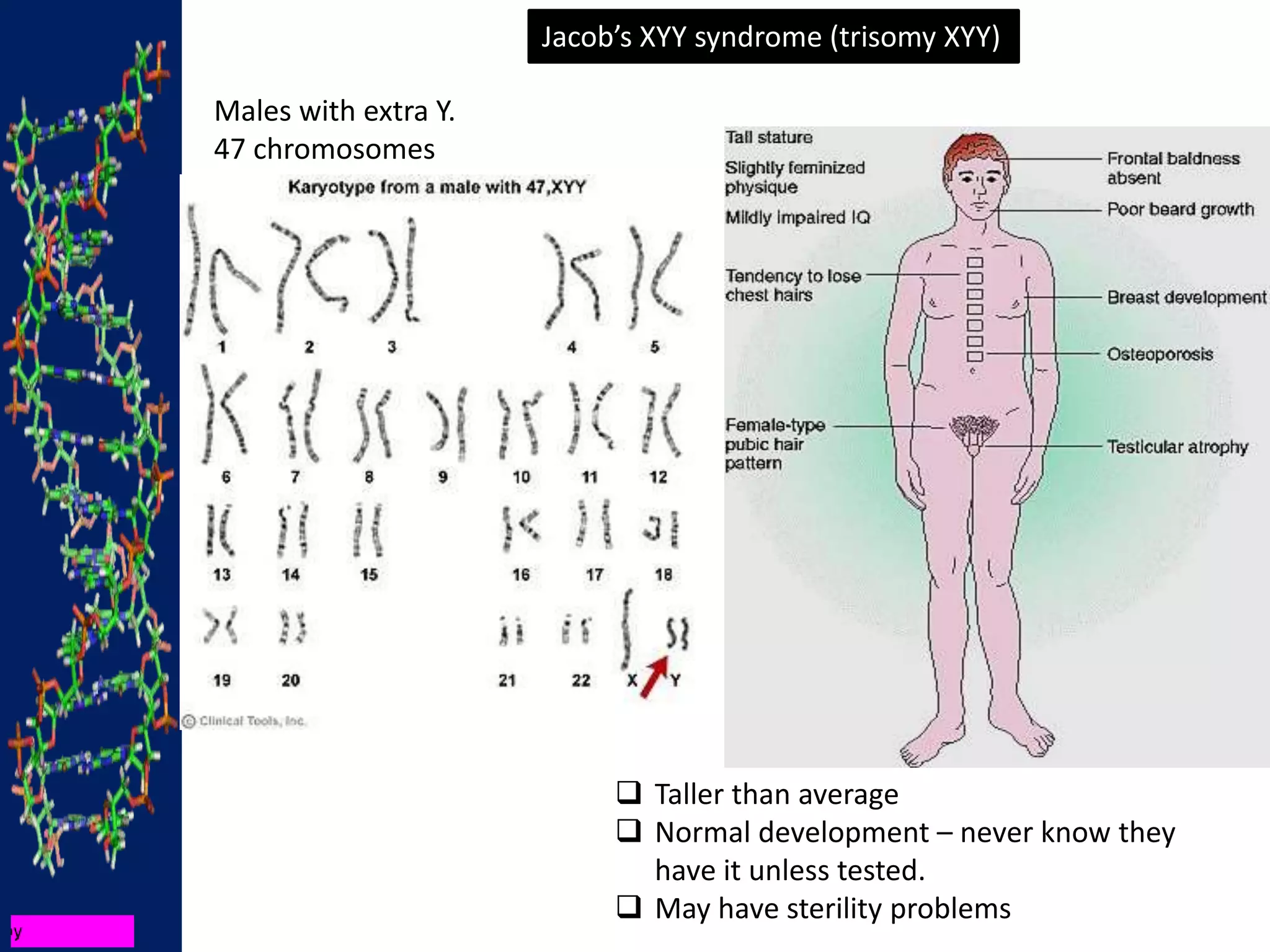 Jacob’s XYY syndrome (trisomy XYY)
 Taller than average
 Normal development – never know they
have it unless tested.
 May have sterility problems
Males with extra Y.
47 chromosomes
 