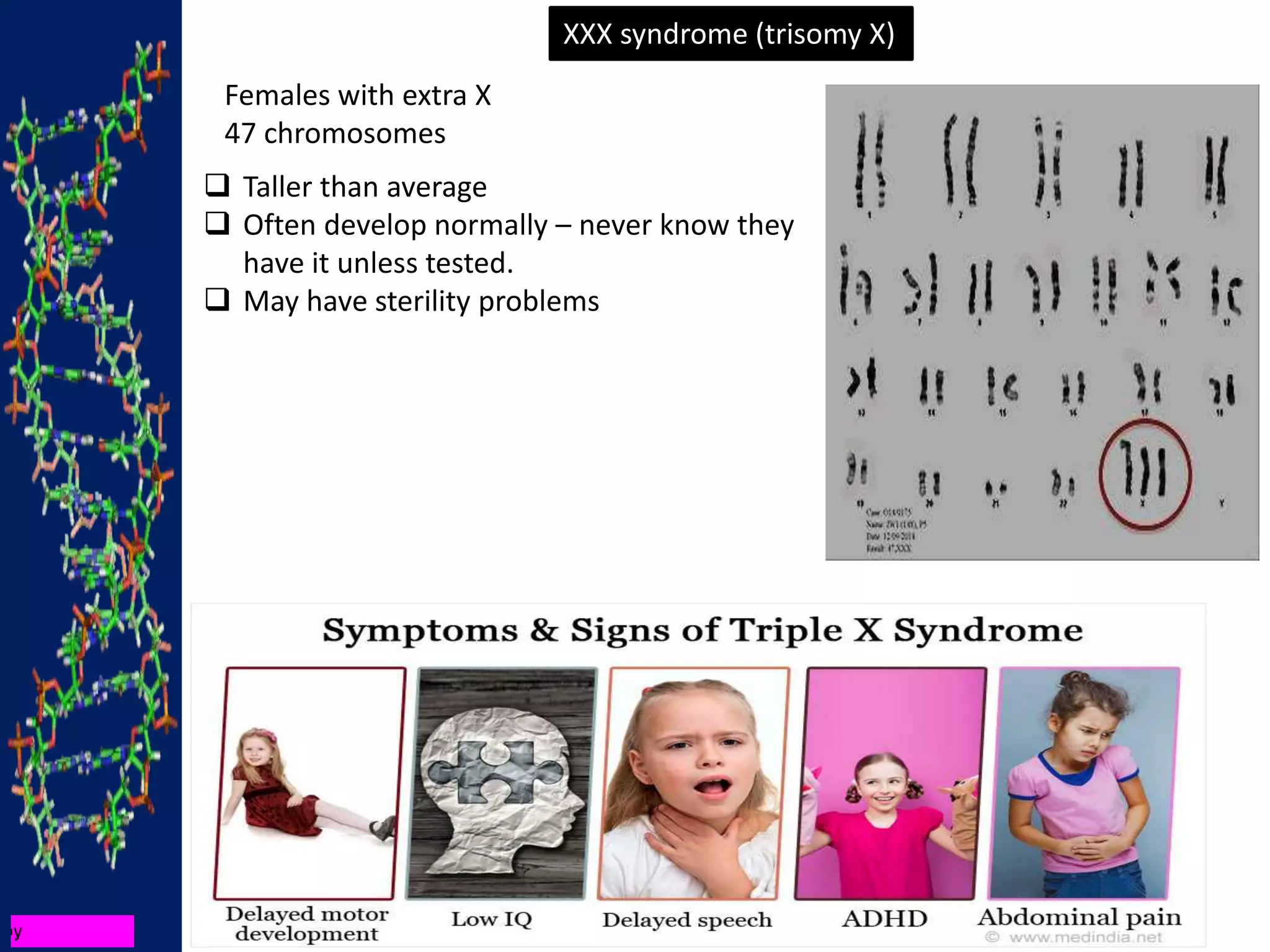 XXX syndrome (trisomy X)
 Taller than average
 Often develop normally – never know they
have it unless tested.
 May have sterility problems
Females with extra X
47 chromosomes
 
