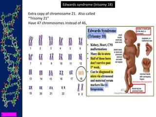 Edwards syndrome (trisomy 18)
Extra copy of chromosome 21. Also called
“Trisomy 21”
Have 47 chromosomes instead of 46,
 