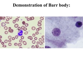 Demonstration of Barr body:
 