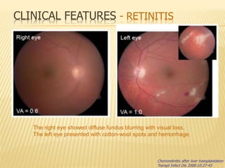 Chorioretinitis after liver transplantation
Transpl Infect Dis 2008:10:27-43
The right eye showed diffuse fundus blurring with visual loss,
The left eye presented with cotton-wool spots and hemorrhage.
CLINICAL FEATURES - RETINITIS
 