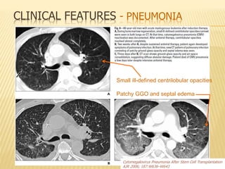 Cytomegalovirus Pneumonia After Stem Cell Transplantation
AJR 2006; 187:W636–W643
Small ill-defined centrilobular opacities
Patchy GGO and septal edema
CLINICAL FEATURES - PNEUMONIA
 