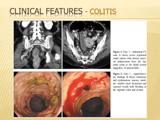 CLINICAL FEATURES - COLITIS
 