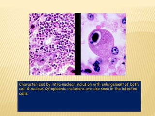 Characterized by intra-nuclear inclusion with enlargement of both
cell & nucleus. Cytoplasmic inclusions are also seen in the infected
cells.
 