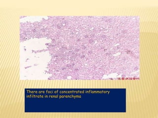 There are foci of concentrated inflammatory
infiltrate in renal parenchyma
 