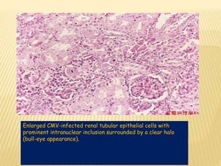 Enlarged CMV-infected renal tubular epithelial cells with
prominent intranuclear inclusion surrounded by a clear halo
(bull-eye appearance).
 
