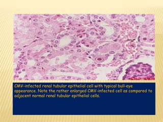 CMV-infected renal tubular epithelial cell with typical bull-eye
appearance. Note the rather enlarged CMV-infected cell as compared to
adjacent normal renal tubular epithelial cells.
 