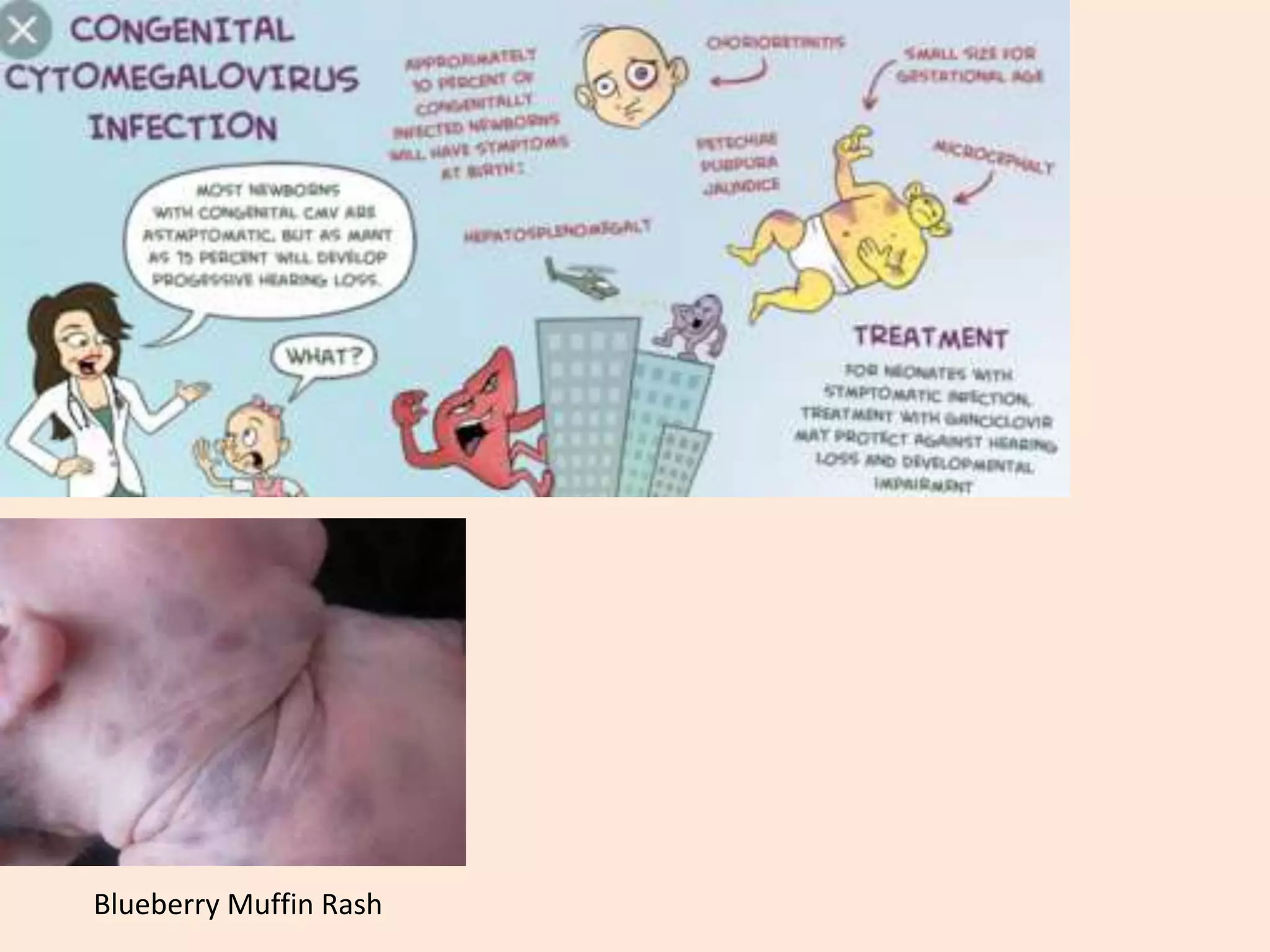 Muffin Rash Cytomegalovirus Made Very Easy! | PPTX