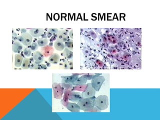 NORMAL SMEAR
 