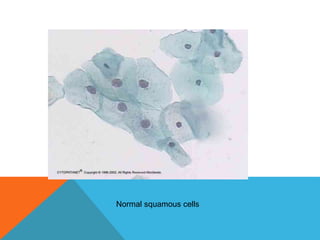 Normal squamous cells
 