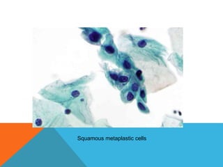 Squamous metaplastic cells
 