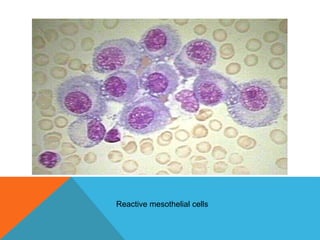 Reactive mesothelial cells
 