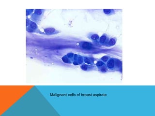 Malignant cells of breast aspirate
 
