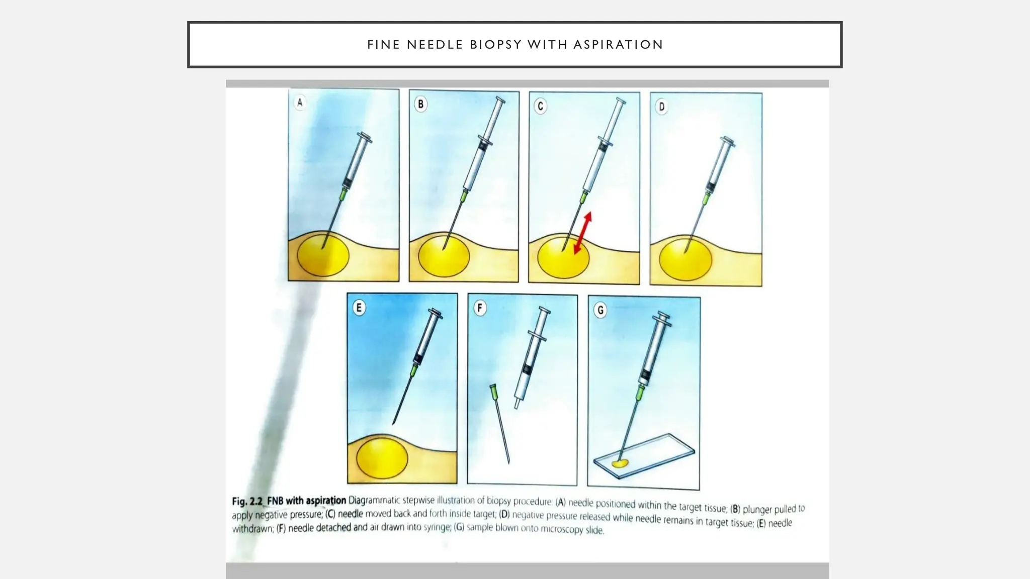 F I N E N E E D L E B I O P S Y W I T H A S P I R AT I O N
 