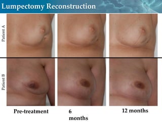 Lumpectomy Reconstruction
Patient A
Patient B




            Pre-treatment   6        12 months
                            months      Cell Therapy
 