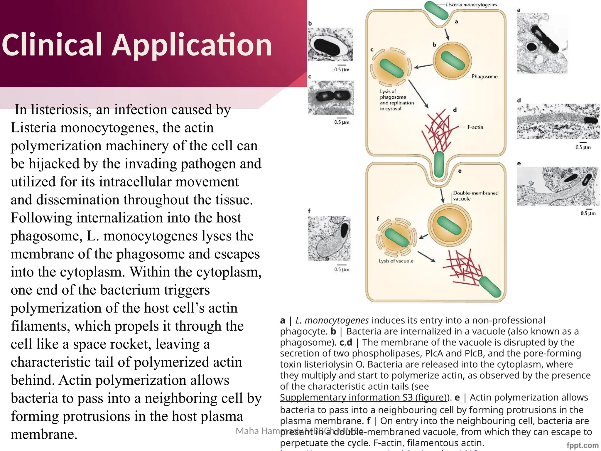 Maha Hammady,MBBCh,MMSc
In listeriosis, an infection caused by
Listeria monocytogenes, the actin
polymerization machinery of the cell can
be hijacked by the invading pathogen and
utilized for its intracellular movement
and dissemination throughout the tissue.
Following internalization into the host
phagosome, L. monocytogenes lyses the
membrane of the phagosome and escapes
into the cytoplasm. Within the cytoplasm,
one end of the bacterium triggers
polymerization of the host cell’s actin
filaments, which propels it through the
cell like a space rocket, leaving a
characteristic tail of polymerized actin
behind. Actin polymerization allows
bacteria to pass into a neighboring cell by
forming protrusions in the host plasma
membrane.
Clinical Application
a | L. monocytogenes induces its entry into a non-professional
phagocyte. b | Bacteria are internalized in a vacuole (also known as a
phagosome). c,d | The membrane of the vacuole is disrupted by the
secretion of two phospholipases, PlcA and PlcB, and the pore-forming
toxin listeriolysin O. Bacteria are released into the cytoplasm, where
they multiply and start to polymerize actin, as observed by the presence
of the characteristic actin tails (see
Supplementary information S3 (figure)). e | Actin polymerization allows
bacteria to pass into a neighbouring cell by forming protrusions in the
plasma membrane. f | On entry into the neighbouring cell, bacteria are
present in a double-membraned vacuole, from which they can escape to
perpetuate the cycle. F-actin, filamentous actin.
 