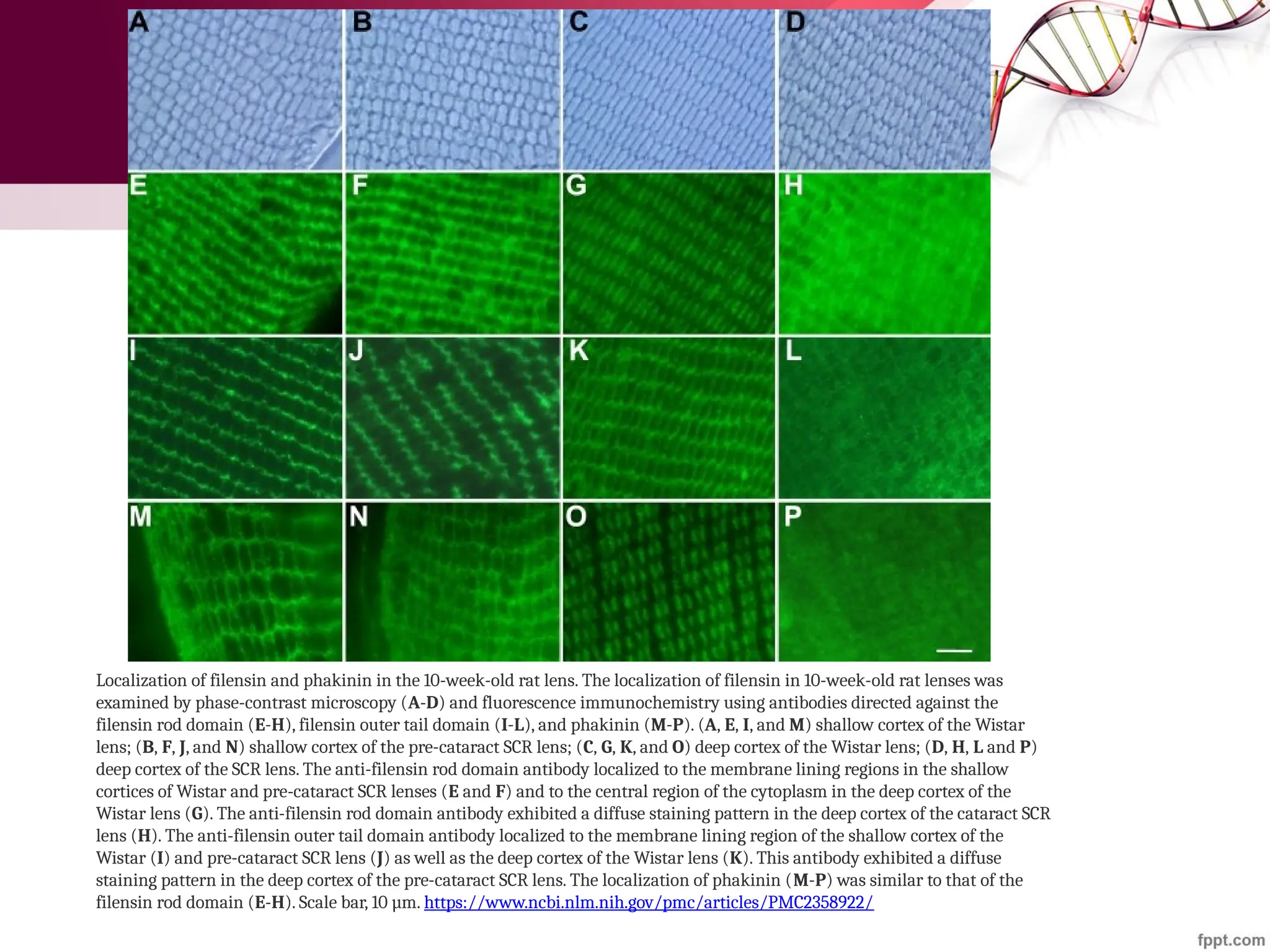 Localization of filensin and phakinin in the 10-week-old rat lens. The localization of filensin in 10-week-old rat lenses was
examined by phase-contrast microscopy (A-D) and fluorescence immunochemistry using antibodies directed against the
filensin rod domain (E-H), filensin outer tail domain (I-L), and phakinin (M-P). (A, E, I, and M) shallow cortex of the Wistar
lens; (B, F, J, and N) shallow cortex of the pre-cataract SCR lens; (C, G, K, and O) deep cortex of the Wistar lens; (D, H, L and P)
deep cortex of the SCR lens. The anti-filensin rod domain antibody localized to the membrane lining regions in the shallow
cortices of Wistar and pre-cataract SCR lenses (E and F) and to the central region of the cytoplasm in the deep cortex of the
Wistar lens (G). The anti-filensin rod domain antibody exhibited a diffuse staining pattern in the deep cortex of the cataract SCR
lens (H). The anti-filensin outer tail domain antibody localized to the membrane lining region of the shallow cortex of the
Wistar (I) and pre-cataract SCR lens (J) as well as the deep cortex of the Wistar lens (K). This antibody exhibited a diffuse
staining pattern in the deep cortex of the pre-cataract SCR lens. The localization of phakinin (M-P) was similar to that of the
filensin rod domain (E-H). Scale bar, 10 µm. https://www.ncbi.nlm.nih.gov/pmc/articles/PMC2358922/
 