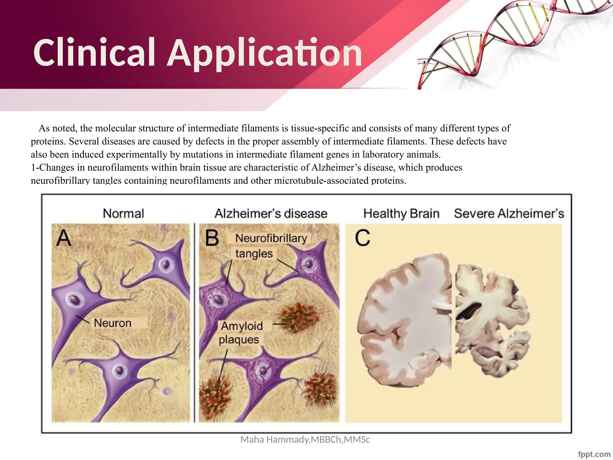 Maha Hammady,MBBCh,MMSc
Clinical Application
As noted, the molecular structure of intermediate filaments is tissue-specific and consists of many different types of
proteins. Several diseases are caused by defects in the proper assembly of intermediate filaments. These defects have
also been induced experimentally by mutations in intermediate filament genes in laboratory animals.
1-Changes in neurofilaments within brain tissue are characteristic of Alzheimer’s disease, which produces
neurofibrillary tangles containing neurofilaments and other microtubule-associated proteins.
 