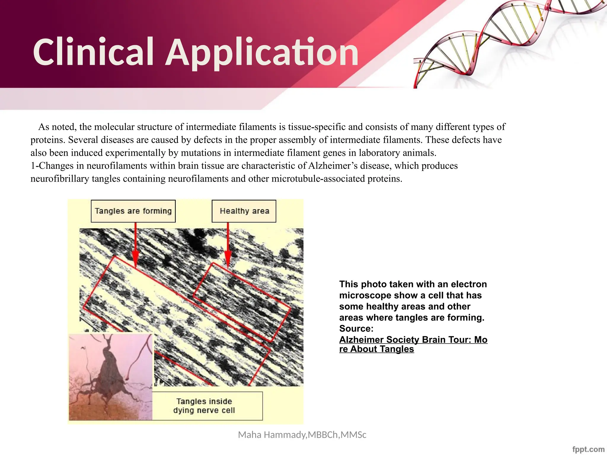Maha Hammady,MBBCh,MMSc
Clinical Application
As noted, the molecular structure of intermediate filaments is tissue-specific and consists of many different types of
proteins. Several diseases are caused by defects in the proper assembly of intermediate filaments. These defects have
also been induced experimentally by mutations in intermediate filament genes in laboratory animals.
1-Changes in neurofilaments within brain tissue are characteristic of Alzheimer’s disease, which produces
neurofibrillary tangles containing neurofilaments and other microtubule-associated proteins.
This photo taken with an electron
microscope show a cell that has
some healthy areas and other
areas where tangles are forming.
Source:
Alzheimer Society Brain Tour: Mo
re About Tangles
 