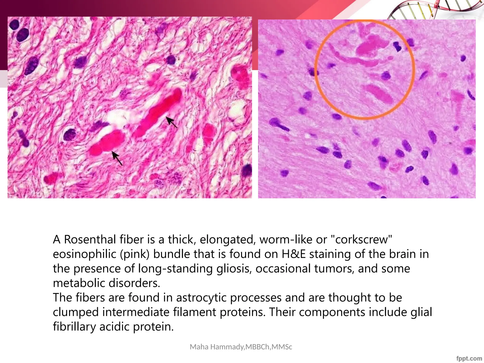 Maha Hammady,MBBCh,MMSc
A Rosenthal fiber is a thick, elongated, worm-like or "corkscrew"
eosinophilic (pink) bundle that is found on H&E staining of the brain in
the presence of long-standing gliosis, occasional tumors, and some
metabolic disorders.
The fibers are found in astrocytic processes and are thought to be
clumped intermediate filament proteins. Their components include glial
fibrillary acidic protein.
 