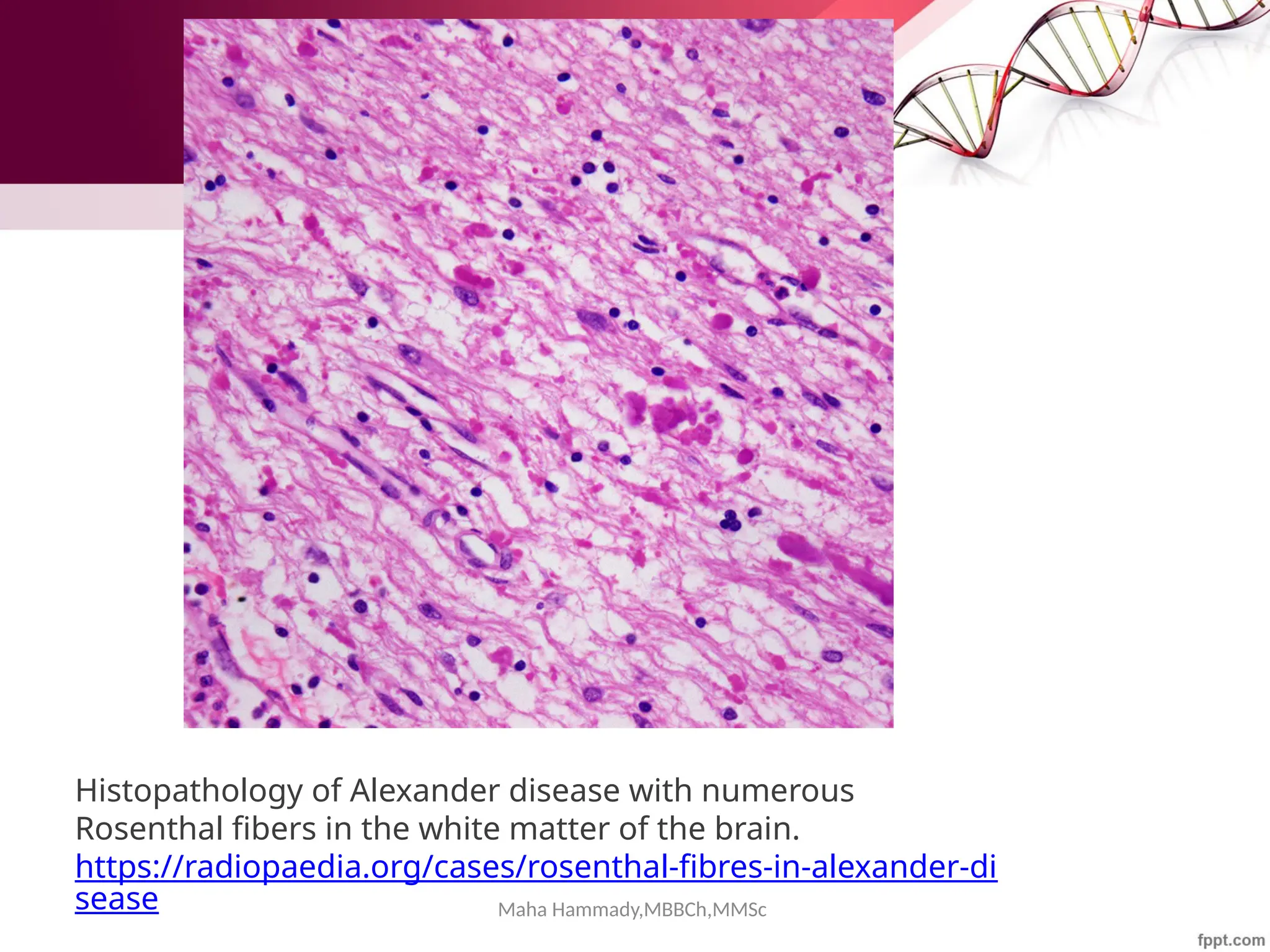 Maha Hammady,MBBCh,MMSc
Histopathology of Alexander disease with numerous
Rosenthal fibers in the white matter of the brain.
https://radiopaedia.org/cases/rosenthal-fibres-in-alexander-di
sease
 