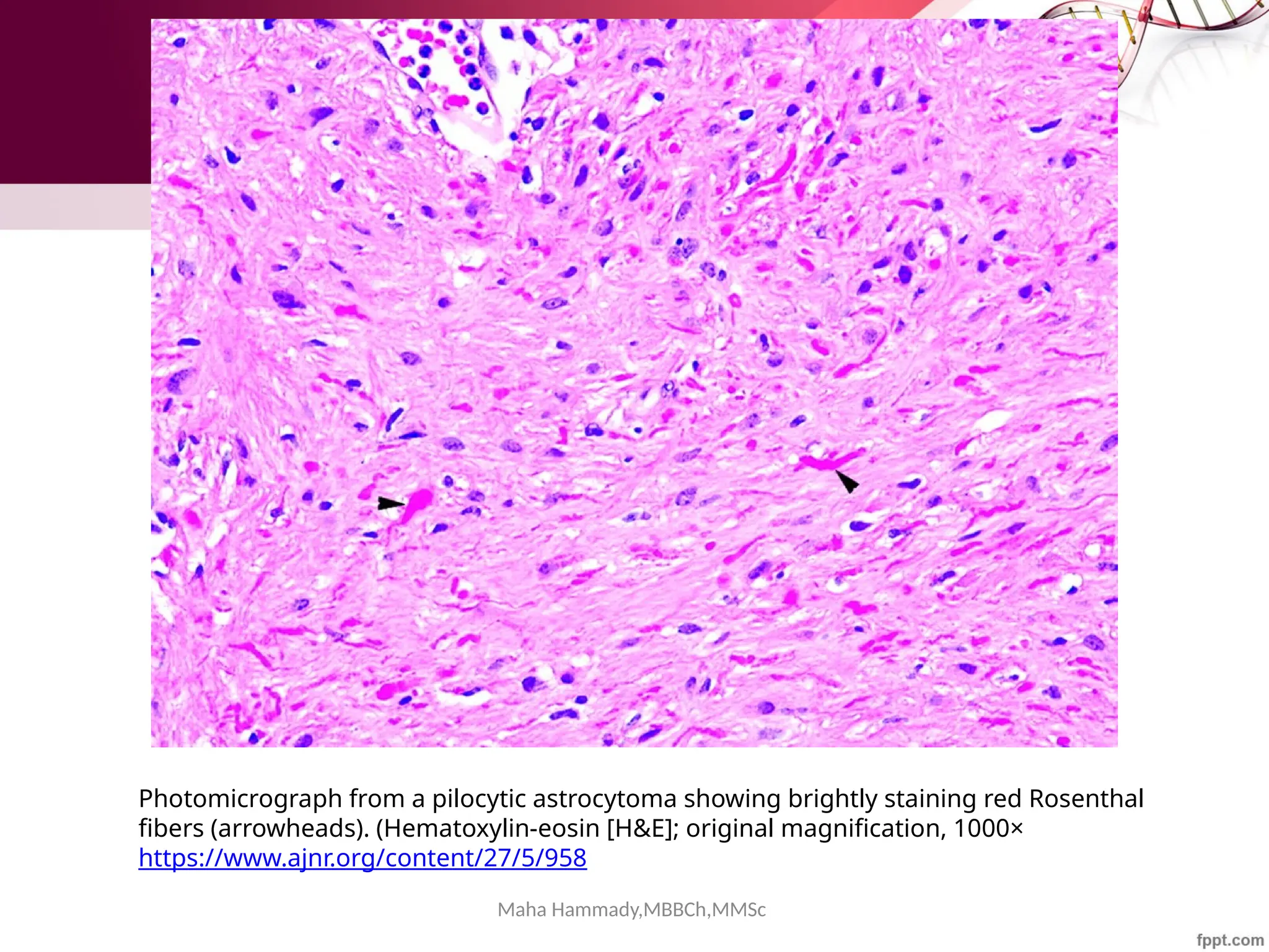 Maha Hammady,MBBCh,MMSc
Photomicrograph from a pilocytic astrocytoma showing brightly staining red Rosenthal
fibers (arrowheads). (Hematoxylin-eosin [H&E]; original magnification, 1000×
https://www.ajnr.org/content/27/5/958
 