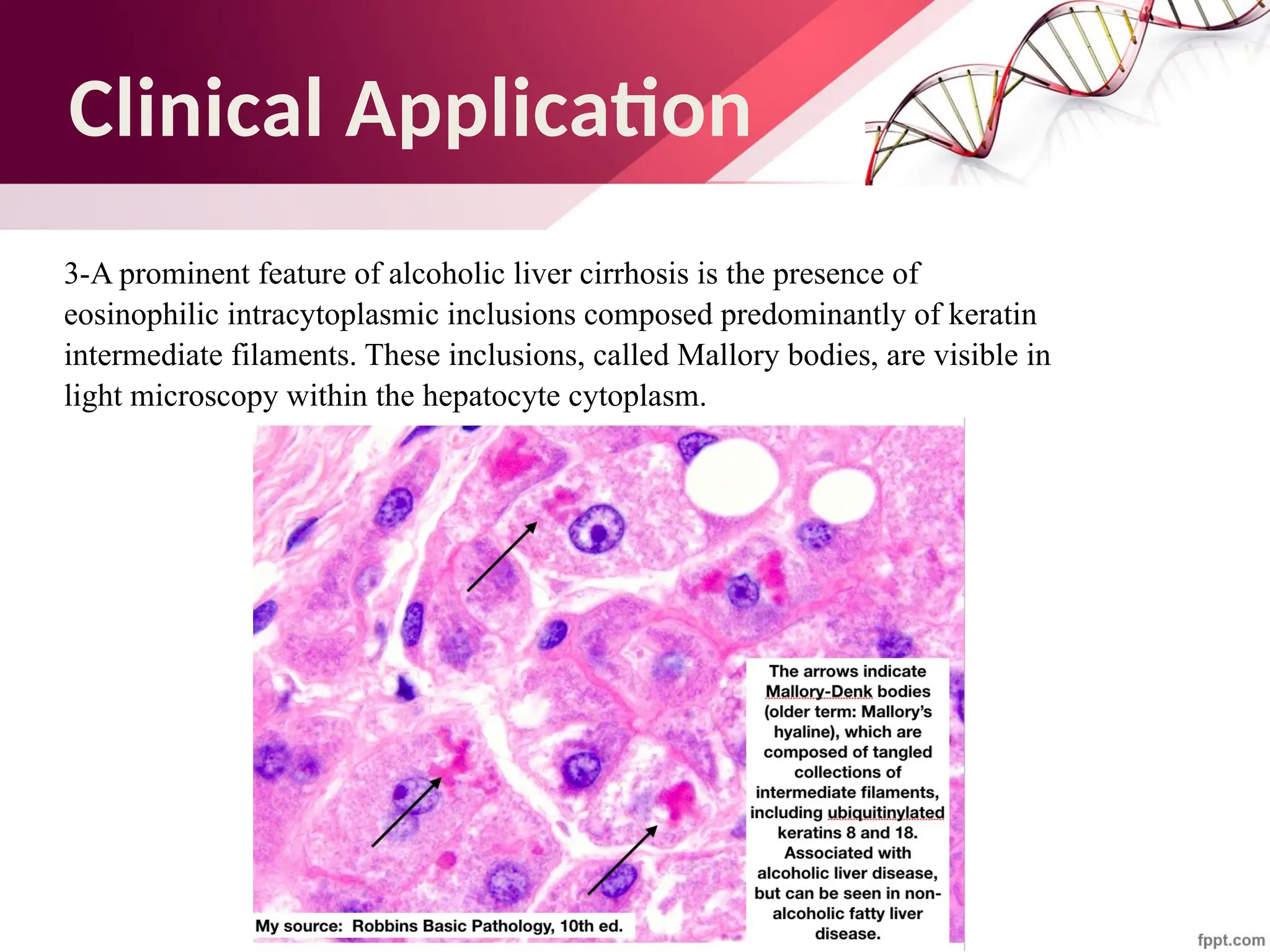 Maha Hammady,MBBCh,MMSc
Clinical Application
3-A prominent feature of alcoholic liver cirrhosis is the presence of
eosinophilic intracytoplasmic inclusions composed predominantly of keratin
intermediate filaments. These inclusions, called Mallory bodies, are visible in
light microscopy within the hepatocyte cytoplasm.
 