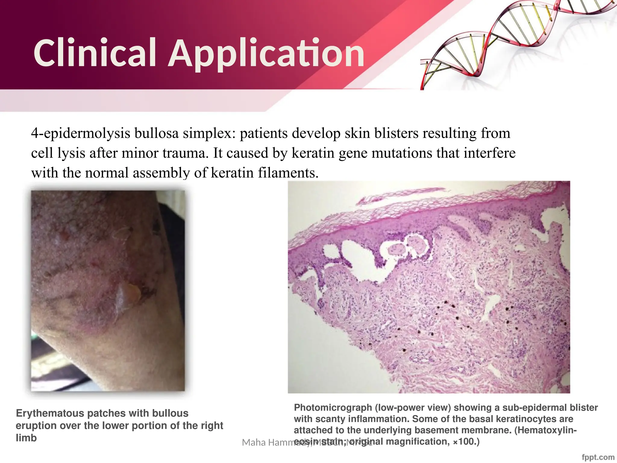 Clinical Application
4-epidermolysis bullosa simplex: patients develop skin blisters resulting from
cell lysis after minor trauma. It caused by keratin gene mutations that interfere
with the normal assembly of keratin filaments.
Maha Hammady,MBBCh,MMSc
Erythematous patches with bullous
eruption over the lower portion of the right
limb
Photomicrograph (low-power view) showing a sub-epidermal blister
with scanty inflammation. Some of the basal keratinocytes are
attached to the underlying basement membrane. (Hematoxylin-
eosin stain; original magnification, ×100.)
 