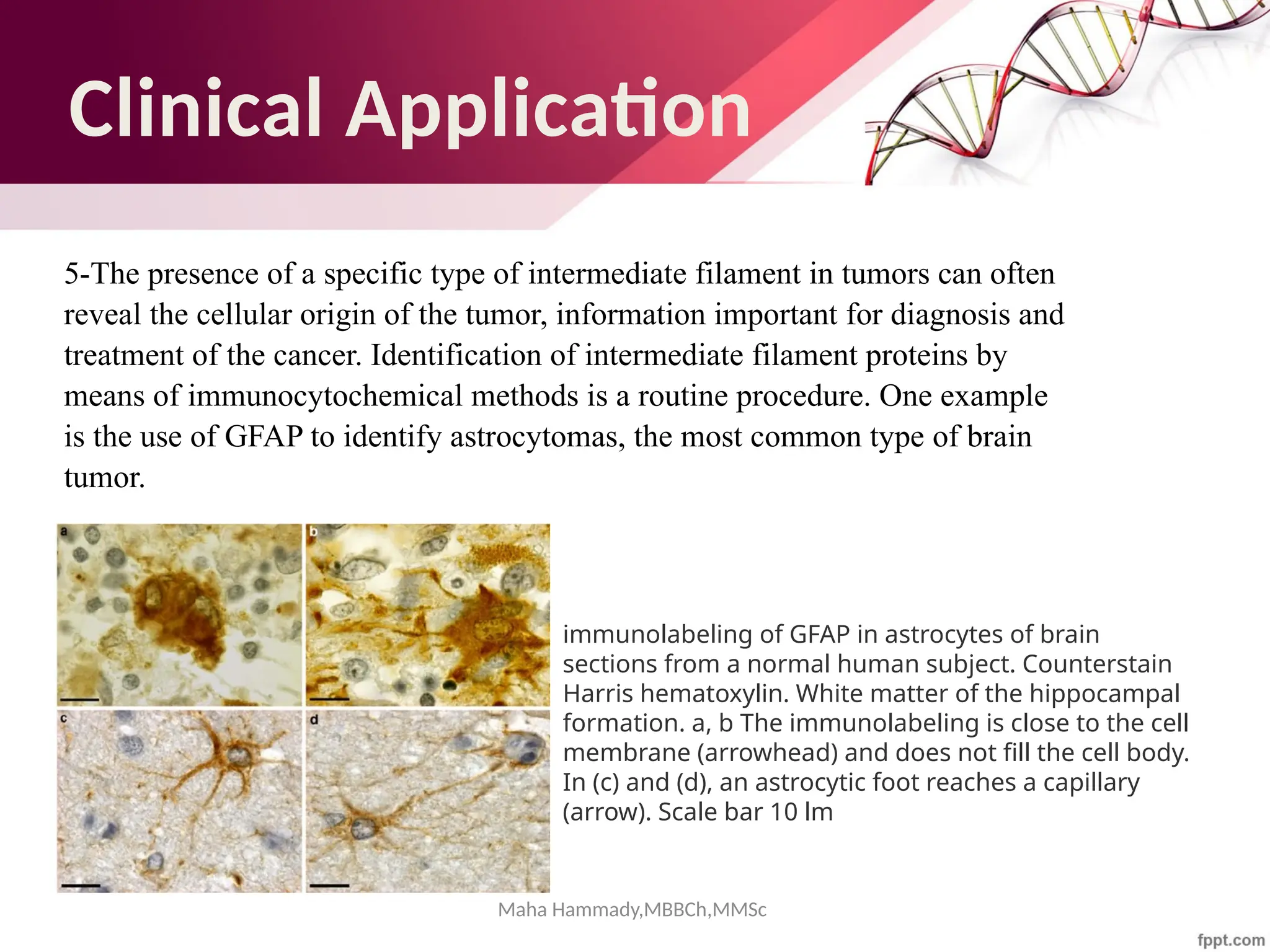 Maha Hammady,MBBCh,MMSc
Clinical Application
5-The presence of a specific type of intermediate filament in tumors can often
reveal the cellular origin of the tumor, information important for diagnosis and
treatment of the cancer. Identification of intermediate filament proteins by
means of immunocytochemical methods is a routine procedure. One example
is the use of GFAP to identify astrocytomas, the most common type of brain
tumor.
immunolabeling of GFAP in astrocytes of brain
sections from a normal human subject. Counterstain
Harris hematoxylin. White matter of the hippocampal
formation. a, b The immunolabeling is close to the cell
membrane (arrowhead) and does not fill the cell body.
In (c) and (d), an astrocytic foot reaches a capillary
(arrow). Scale bar 10 lm
 