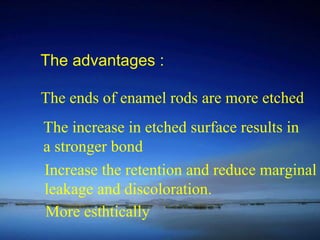 The advantages : The ends of enamel rods are more etched The increase in etched surface results in a stronger bond Increase the retention and reduce marginal leakage and discoloration.  More esthtically 