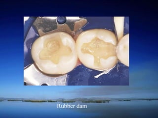 Rubber dam 