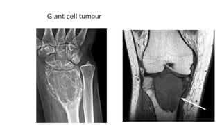 Giant cell tumour
 