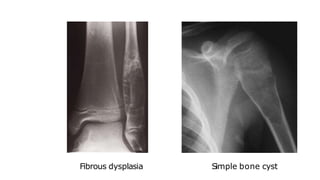 Fibrous dysplasia Simple bone cyst
 