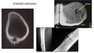 Osteoid osteoma
 