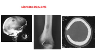 Eosinophil granuloma
 