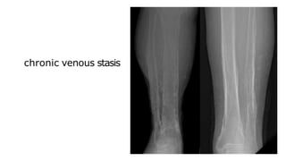 chronic venous stasis
 
